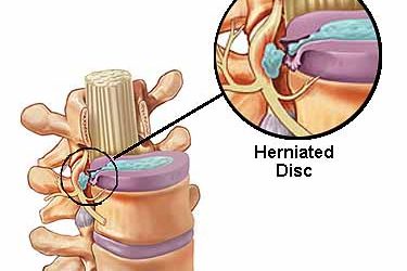 Herniated Disc Management