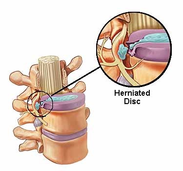 Herniated Disc Management - PHG  Pro Active Health Group Calgary